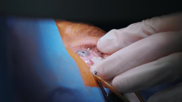 Διόρθωση Όρασης Λέιζερ Ασθενής Και Ομάδα Χειρουργών Στο Χειρουργείο Κατά — Αρχείο Βίντεο