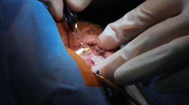 Lazer görüş düzeltmesi. Bir hasta ve bir cerrah ekibi göz ameliyatı sırasında ameliyathanede. Göz spekulumu. Lazer tedavisi. Hasta steril koruma altında.