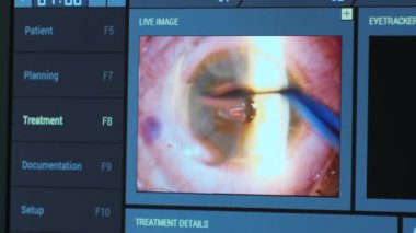 Ototimik cerrahi. Ameliyathanedeki tıbbi monitörden bakın. Lazer.