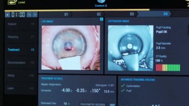 Ototimik cerrahi. Ameliyathanedeki tıbbi monitörden bakın. Lazer.