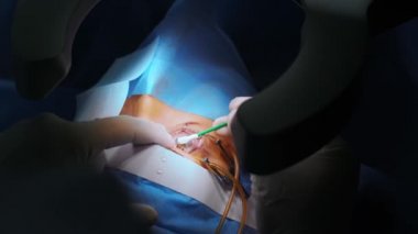 Lazer görüş düzeltmesi. Bir hasta ve bir cerrah ekibi göz ameliyatı sırasında ameliyathanede. Göz spekulumu. Lazer tedavisi. Hasta steril koruma altında.