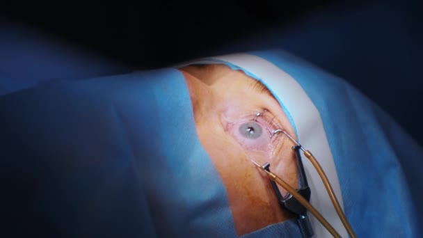 Correzione Della Visione Laser Paziente Team Chirurghi Sala Operatoria Durante — Video Stock