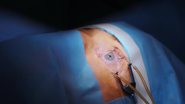 337 Lasik Videos, Royalty-free Stock Lasik Footage | Depositphotos 337 Lasik Videos, Royalty-free Stock Lasik Footage | Depositphotos