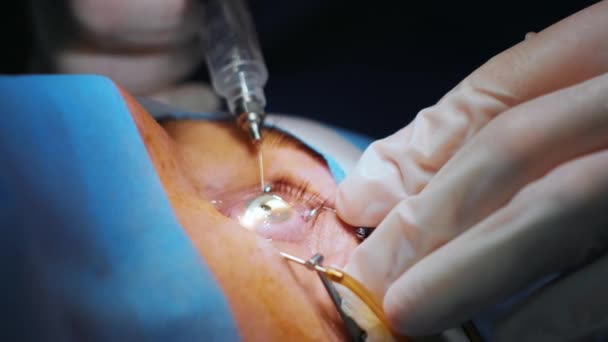 激光视力矫正 眼科手术病人和一组外科医生在手术室进行眼科手术 眼皮的投机 Lasik治疗 不孕不孕病人 — 图库视频影像