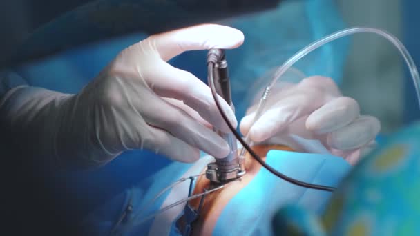 激光视力矫正 眼科手术病人和一组外科医生在手术室进行眼科手术 眼皮的投机 Lasik治疗 不孕不孕病人 — 图库视频影像