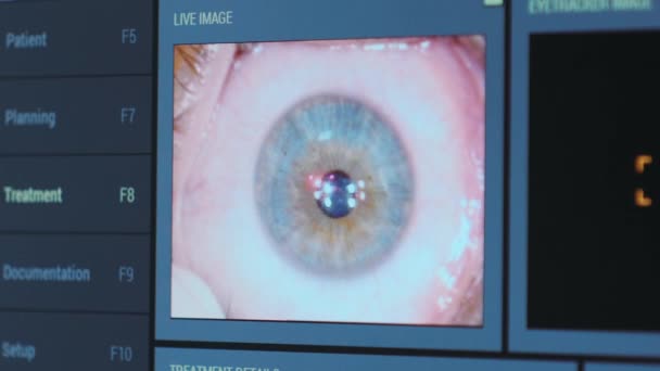 Augenchirurgie Blick Auf Den Bildschirm Des Medizinischen Monitors Operationssaal Lasik — Stockvideo