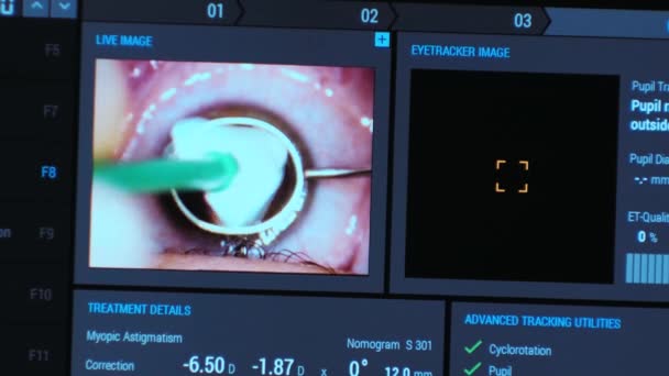Οφθαλμική Χειρουργική Επέμβαση Προβολή Στην Οθόνη Της Ιατρικής Παρακολούθησης Στο — Αρχείο Βίντεο