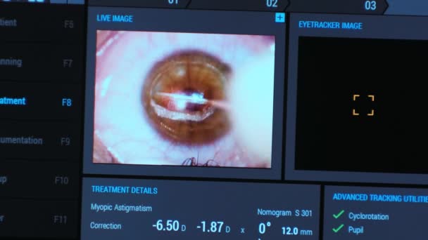 Οφθαλμική Χειρουργική Επέμβαση Προβολή Στην Οθόνη Της Ιατρικής Παρακολούθησης Στο — Αρχείο Βίντεο