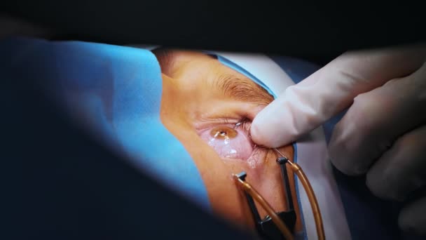 レーザービジョン補正 眼科手術中の手術室の外科医の患者とチーム アイリッド スペクトラム ラシック治療だ 滅菌カバー下の患者 — ストック動画