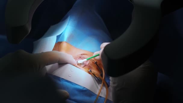 레이저 수술중에 수술실에 환자와 의사들 Eyelid Specguulum 처리를 — 비디오