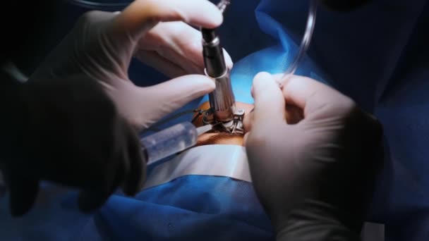 Correction Vue Laser Patient Une Équipe Chirurgiens Dans Salle Opération — Video