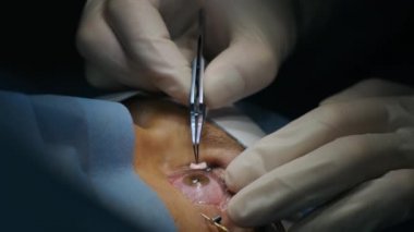 Lazer görüş düzeltmesi. Bir hasta ve bir cerrah ekibi göz ameliyatı sırasında ameliyathanede. Göz spekulumu. Lazer tedavisi. Hasta steril koruma altında.