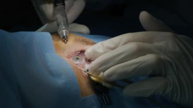Lazer görüş düzeltmesi. Bir hasta ve bir cerrah ekibi göz ameliyatı sırasında ameliyathanede. Göz spekulumu. Lazer tedavisi. Hasta steril koruma altında.