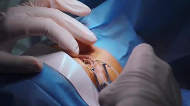 Correction Vue Laser Patient Une Équipe Chirurgiens Dans Salle Opération — Video