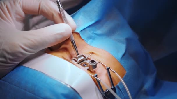 Corrección Visión Láser Paciente Equipo Cirujanos Quirófano Durante Cirugía Oftálmica — Vídeos de Stock