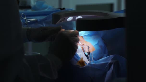 레이저 수술중에 수술실에 환자와 의사들 Eyelid Specguulum 처리를 — 비디오