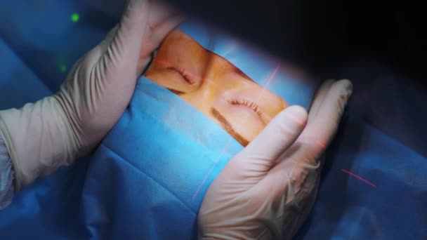 Corrección Visión Láser Paciente Equipo Cirujanos Quirófano Durante Cirugía Oftálmica — Vídeo de stock