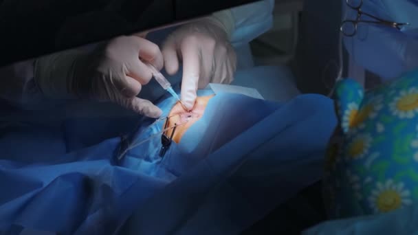 Korekce Laserového Vidění Pacient Tým Chirurgů Operačním Sále Během Oční — Stock video