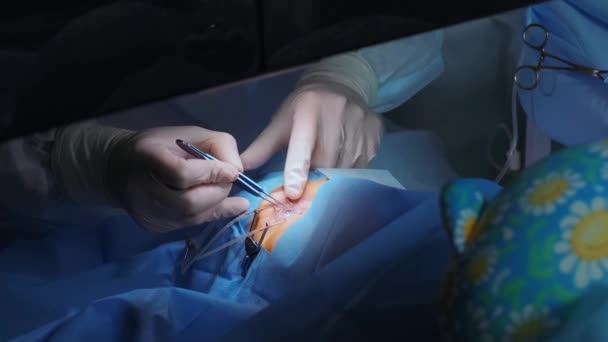 Лазерная Коррекция Зрения Пациент Команда Хирургов Операционной Время Офтальмологической Операции — стоковое видео
