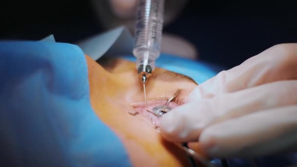Lazer Görüş Düzeltmesi Bir Hasta Bir Cerrah Ekibi Göz Ameliyatı — Stok video