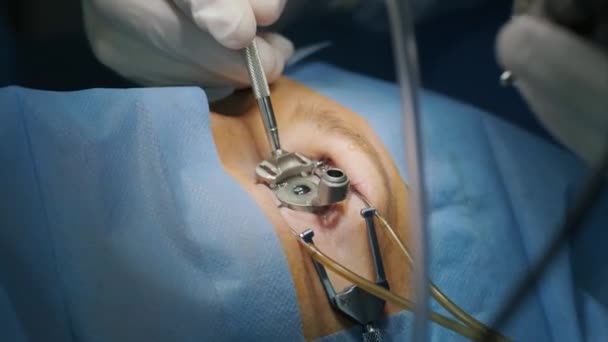 Laser Vision Correction Patient Team Surgeons Operating Room Ophthalmic Surgery — Stock Video