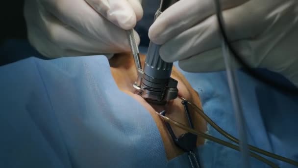 Correction Vue Laser Patient Une Équipe Chirurgiens Dans Salle Opération — Video