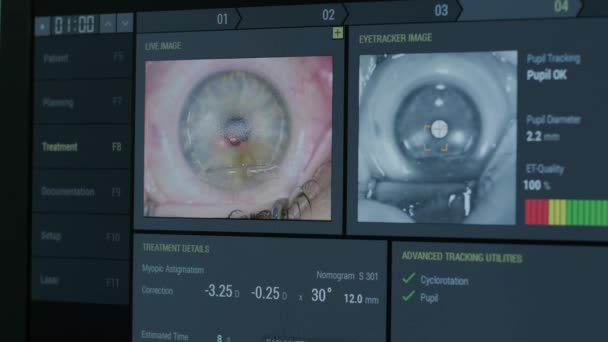 Chirurgia Oftalmica Visualizzazione Sullo Schermo Del Monitor Medico Sala Operatoria — Video Stock