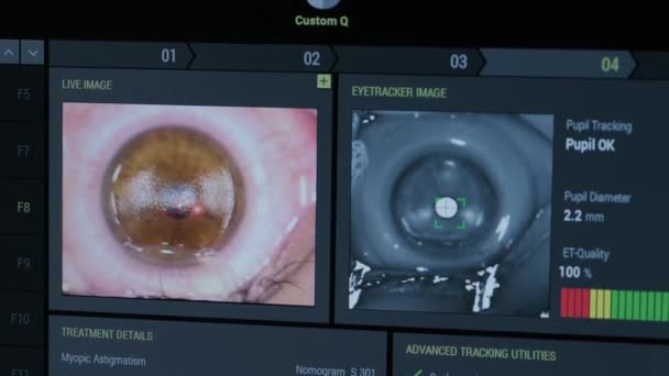 Chirurgia Oftalmica Visualizzazione Sullo Schermo Del Monitor Medico Sala Operatoria — Video Stock
