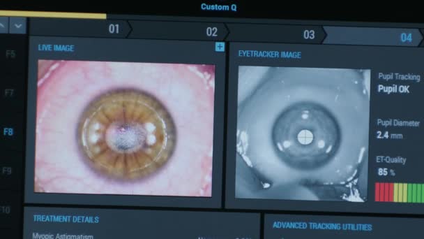 眼科手術です 手術室のモニターの画面で表示されます ラシック — ストック動画
