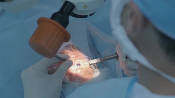 Cirugía Cataratas Cerca Cirujano Operando Cataratas Oculares Cirugía Hospitalaria — Vídeos de Stock