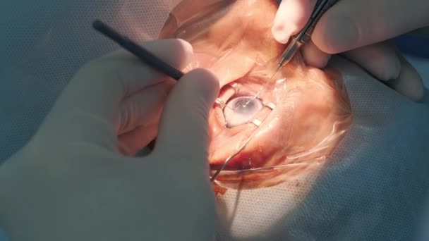 白内障手術が終わりました 病院手術における眼科手術白内障手術 — ストック動画