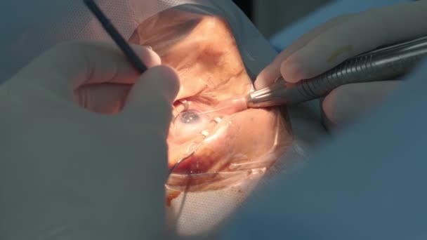 白内障手术近视 医院手术中的手术眼白内障 — 图库视频影像