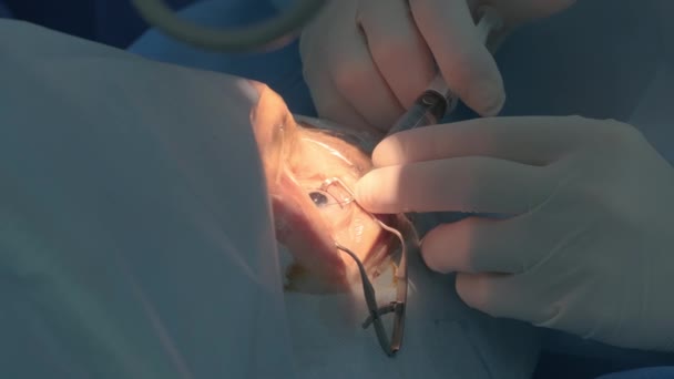 Operace Šedého Zákalu Zblízka Chirurg Operující Oční Kataraktu Nemocniční Chirurgii — Stock video