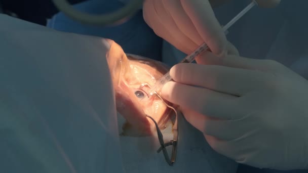 Cataract Operatie Van Dichtbij Chirurg Opererende Oogstaar Ziekenhuis Chirurgie — Stockvideo