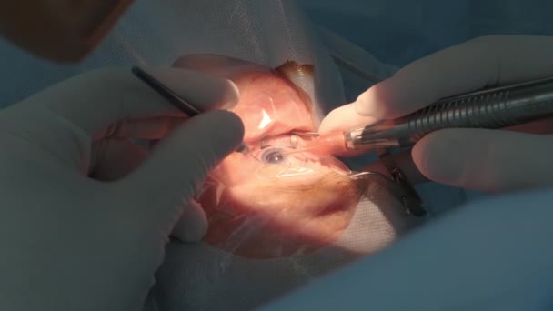 Χειρουργική Επέμβαση Καταρράκτη Κοντά Χειρουργός Χειρουργικός Οφθαλμικός Καταρράκτης Νοσοκομειακή Χειρουργική — Αρχείο Βίντεο