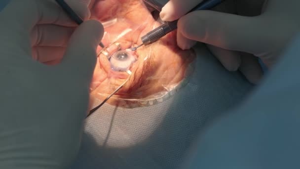 Cirugía Cataratas Cerca Cirujano Operando Cataratas Oculares Cirugía Hospitalaria — Vídeo de stock