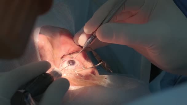 Szürkehályog Műtét Lezárva Szürkehályogot Operáló Sebész Kórházi Műtétnél — Stock videók