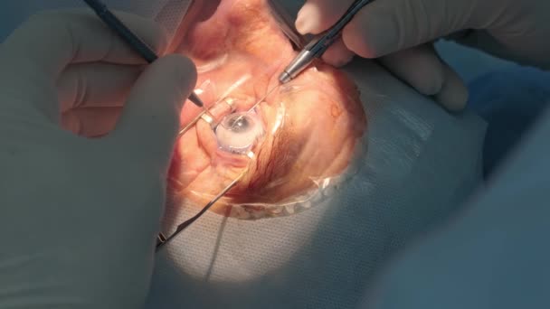 Chirurgie Cataracte Près Chirurgien Opérant Cataracte Oculaire Chirurgie Hospitalière — Video