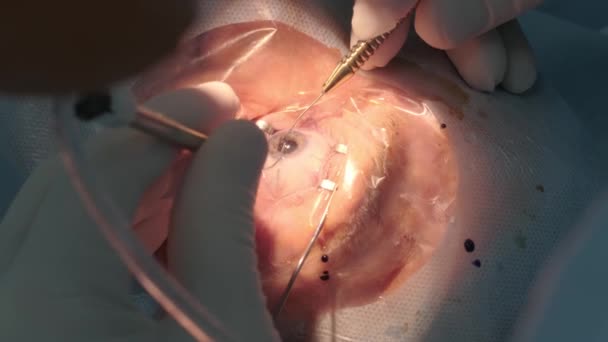 Χειρουργική Επέμβαση Καταρράκτη Κοντά Χειρουργός Χειρουργικός Οφθαλμικός Καταρράκτης Νοσοκομειακή Χειρουργική — Αρχείο Βίντεο