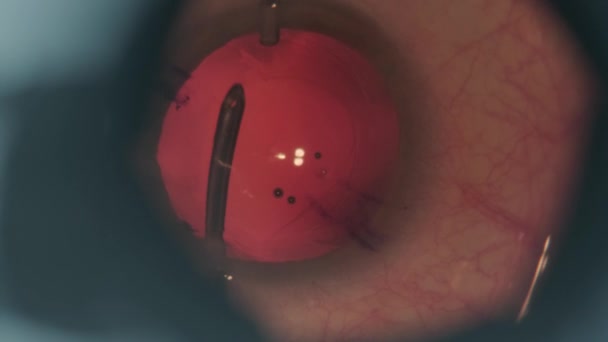 Limpiando Cataratas Ojo Imágenes Macro Eyes Eye Surgery Cirugía Oftalmológica — Vídeo de stock