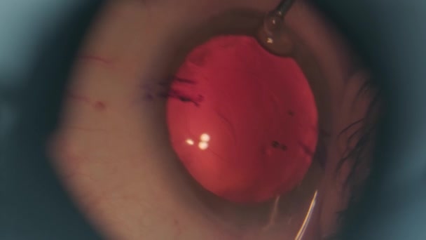 Limpar Catarata Nos Olhos Macro Filmagem Eyes Eye Surgery Cirurgia — Vídeo de Stock