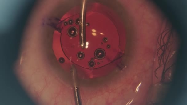 Processus Implantation Lentilles Oculaires Images Macro Yeux Pendant Chirurgie Oculaire — Video