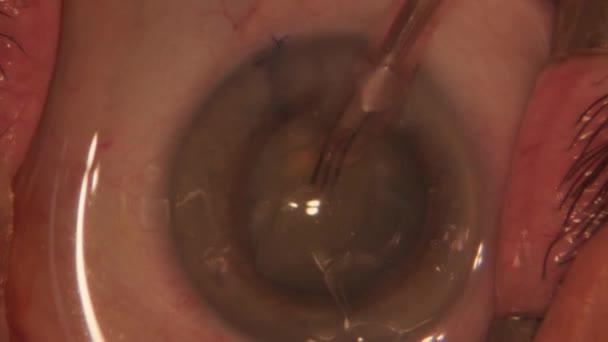 目に白内障をきれいにする 眼手術中の眼のマクロ映像 眼科手術 — ストック動画