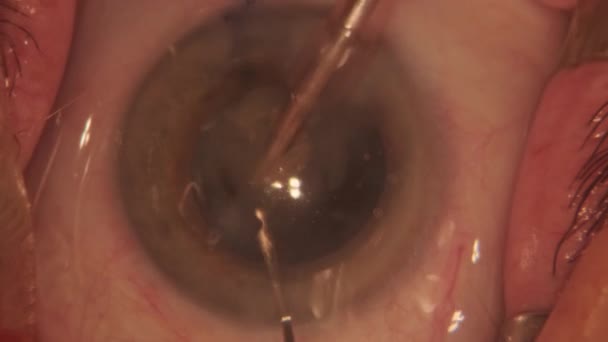 Macro Footage Eyes Eye Surgery Ophthalmological Surgery — Stock Video