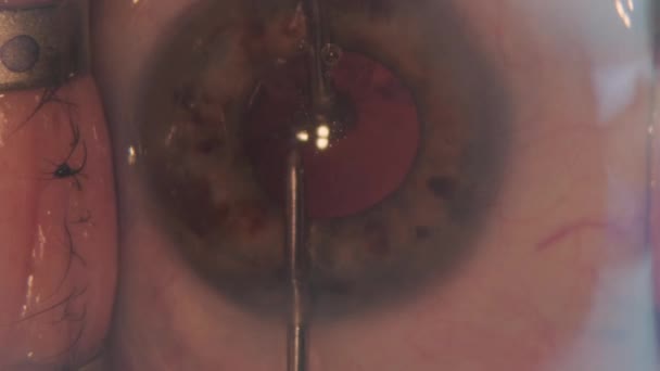 眼手術中の眼のマクロ映像 眼科手術 — ストック動画