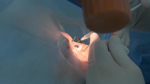 Cataract Operatie Van Dichtbij Chirurg Opererende Oogstaar Ziekenhuis Chirurgie — Stockvideo