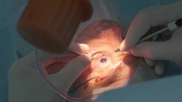 Szürkehályog Műtét Lezárva Szürkehályogot Operáló Sebész Kórházi Műtétnél — Stock videók