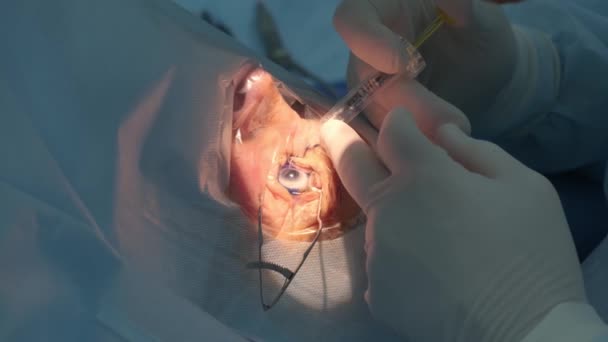 Katarakt Ameliyatı Yakın Çekim Hastane Ameliyatında Cerrah Göz Kataraktı — Stok video