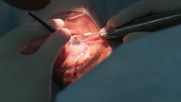 Cataract Operatie Van Dichtbij Chirurg Opererende Oogstaar Ziekenhuis Chirurgie — Stockvideo