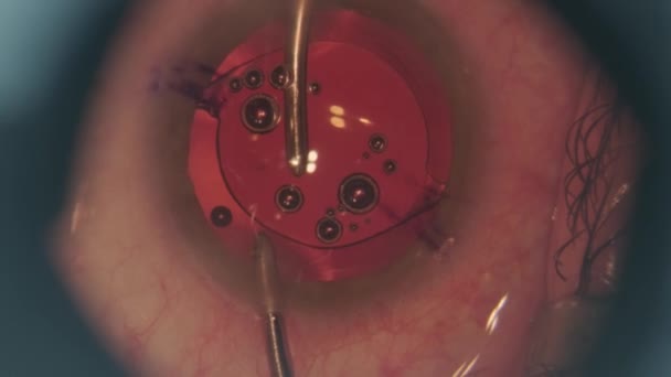 人工晶状体植入过程 眼科手术中的大镜头 眼科手术 — 图库视频影像